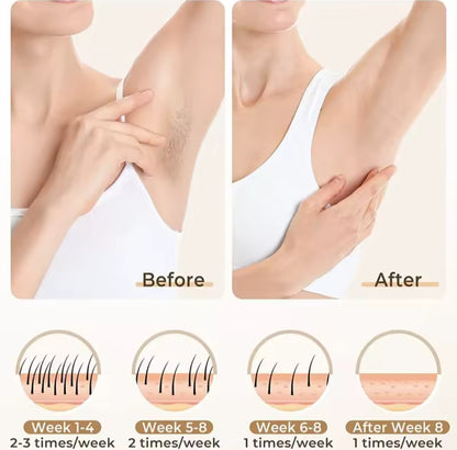 Hair-removal 